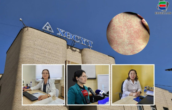 Улаанбурхан өвчний тохиолдол 14 мянган тохиолдол бүртгэгджээ