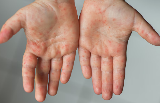 Улаанбурхан өвчний батлагдсан тохиолдол 13648 болжээ